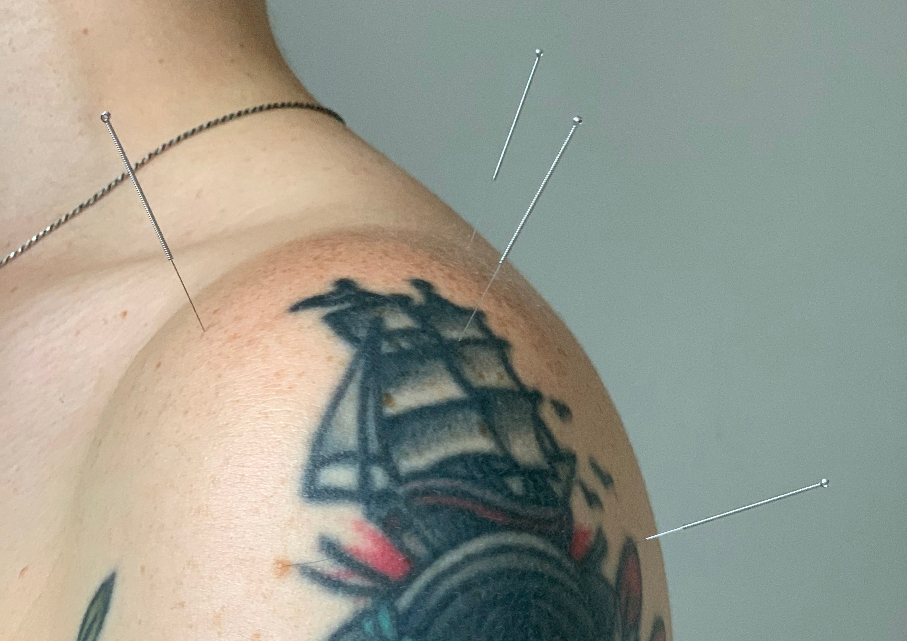 Tiny Needles, Big Relief. <br> A Q&A with Dr. Ming Liu, GingerChi’s licensed acupuncturist - GingerChi