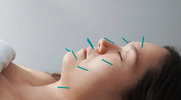 Self Care Series #34 <br> Facial Acupuncture vs. Botox