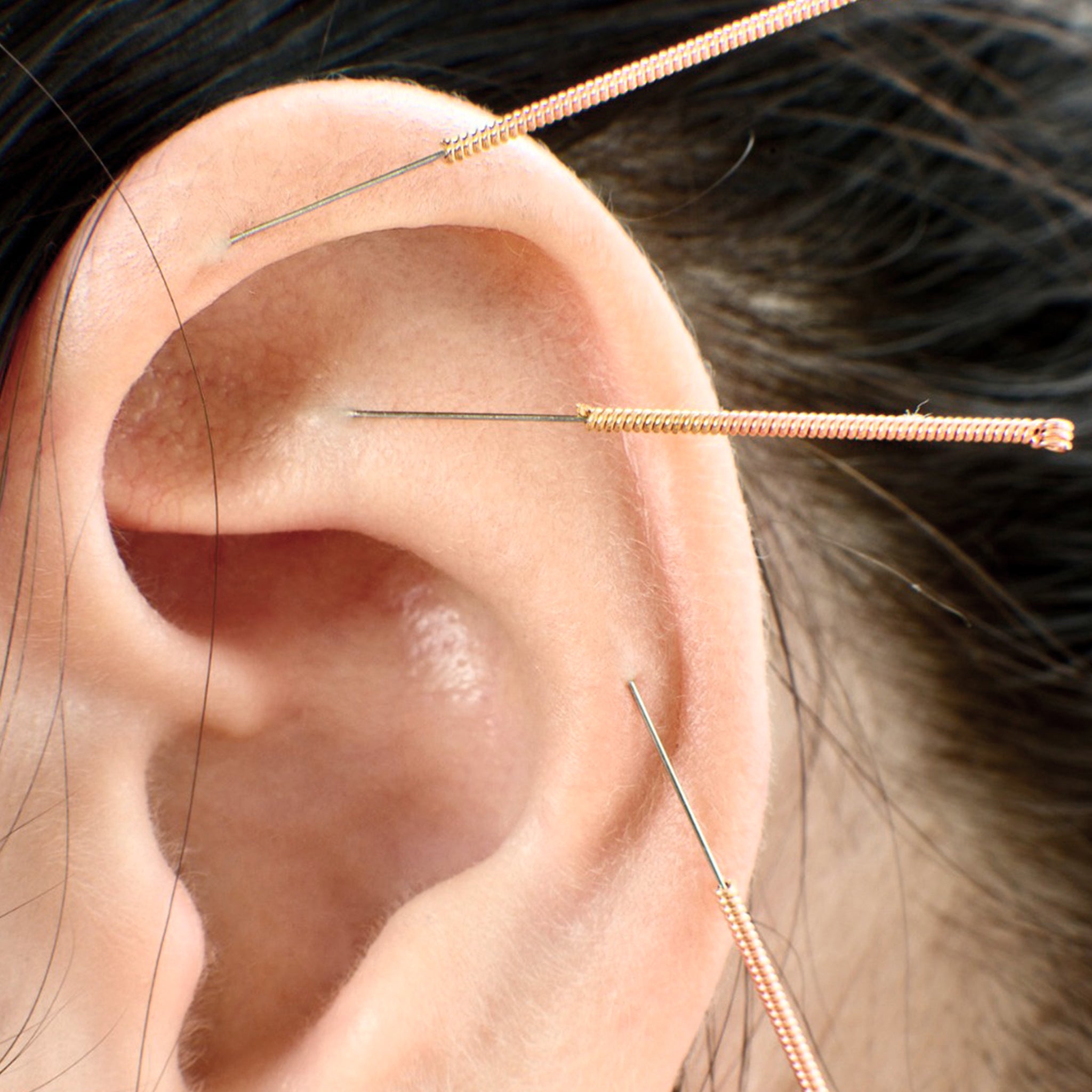 Acupuncture needle in ear